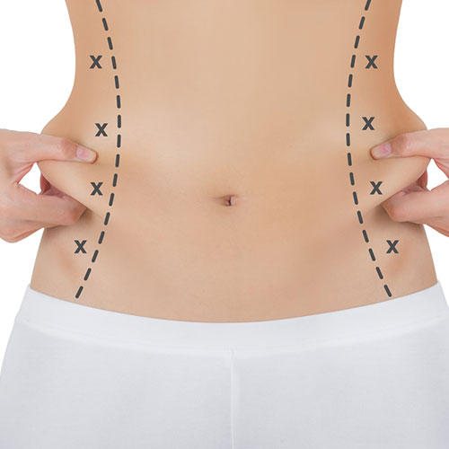 Liposuction Ameliyatında Ne Kadar Yağ Alınabilir ?